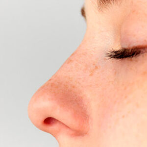 Rinoplastia