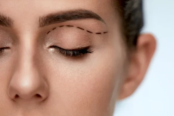Rinoplastia - Imagen 2